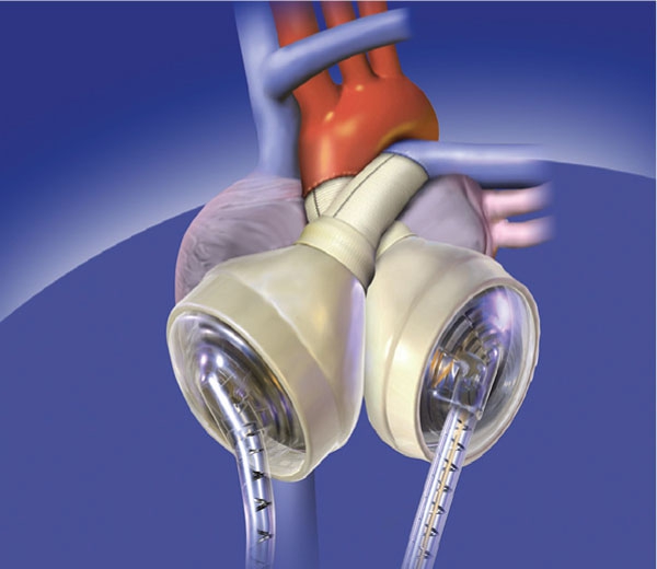 Baptist Health Implants Arkansas’ First Total Artificial Heart